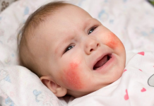 Bé bị chàm, viêm da cơ địa có dùng kem dưỡng ẩm Hoppi được không? kem-duong-am-hoppi-4